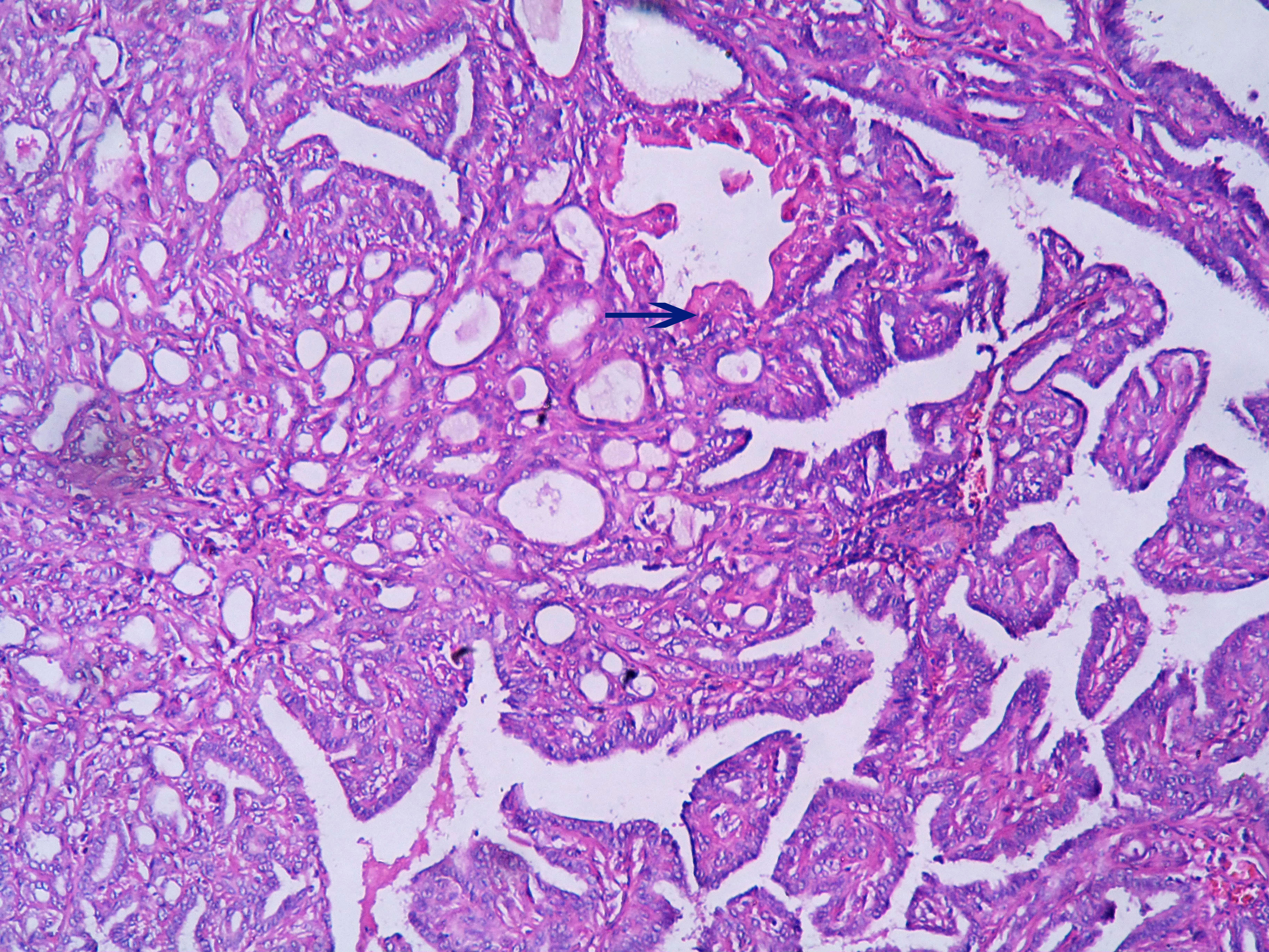 Papilloma with apocrine metaplasia