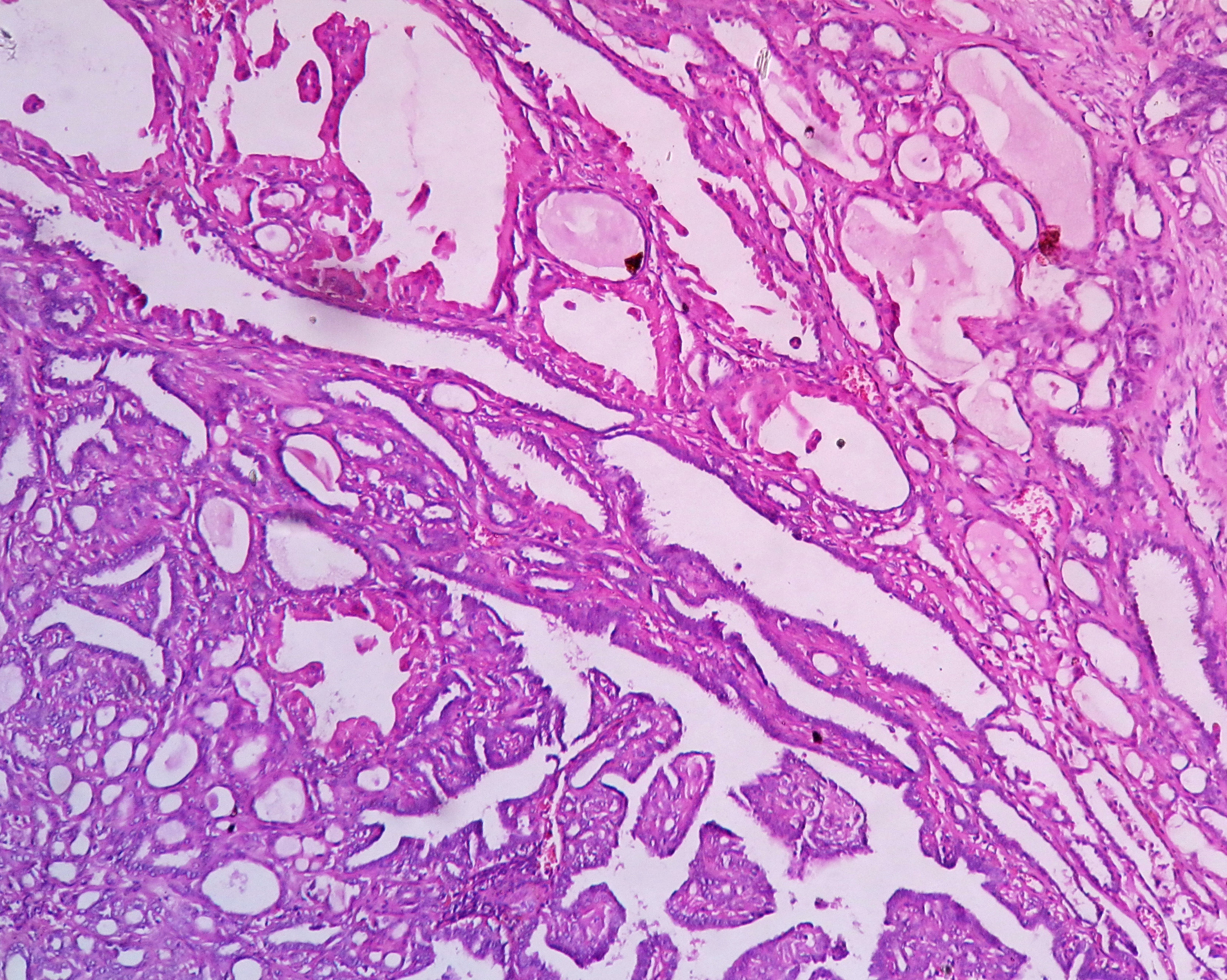 Papiloma intraductal com metaplasia apocrina - Intraductal papilloma with focal apocrine metaplasia