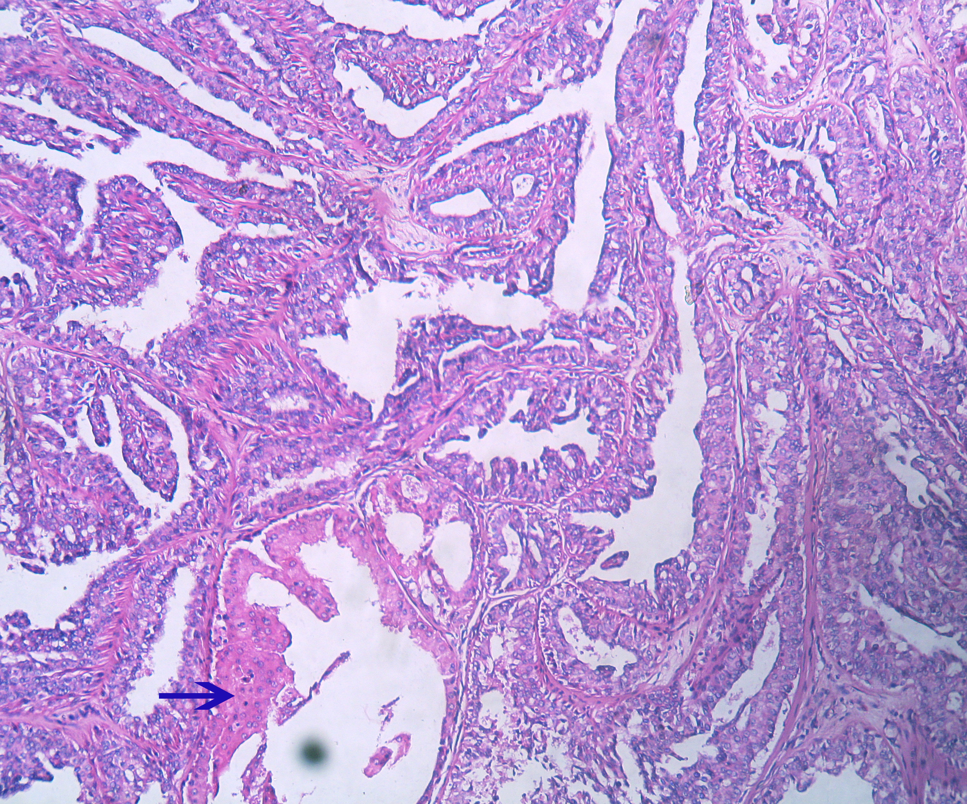 Papiloma intraductal com metaplasia apocrina