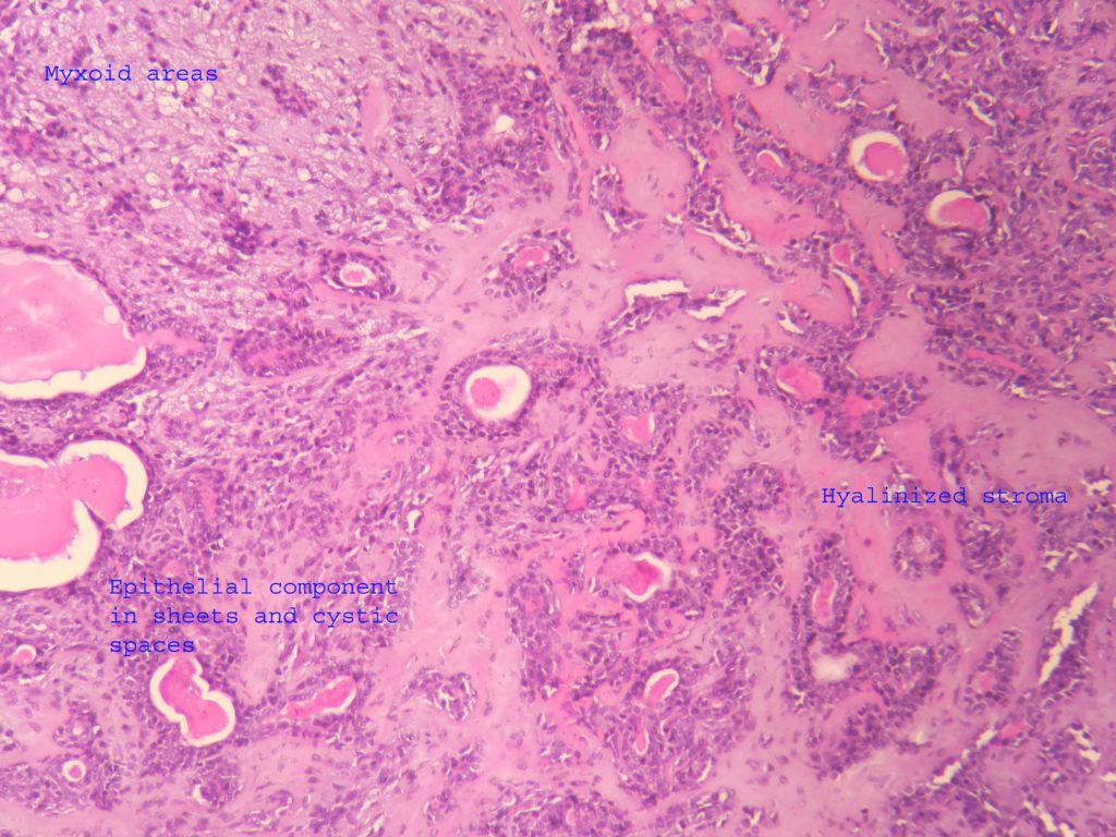 pleomorphic adenoma histology labelled diagram prostatitis betegség 30 évvel