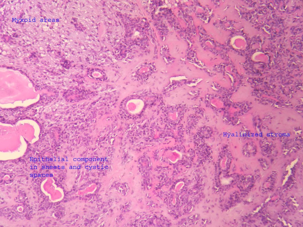 pleomorphic adenoma histology labelled diagram Hogyan befolyásolja a prosztata a potencia
