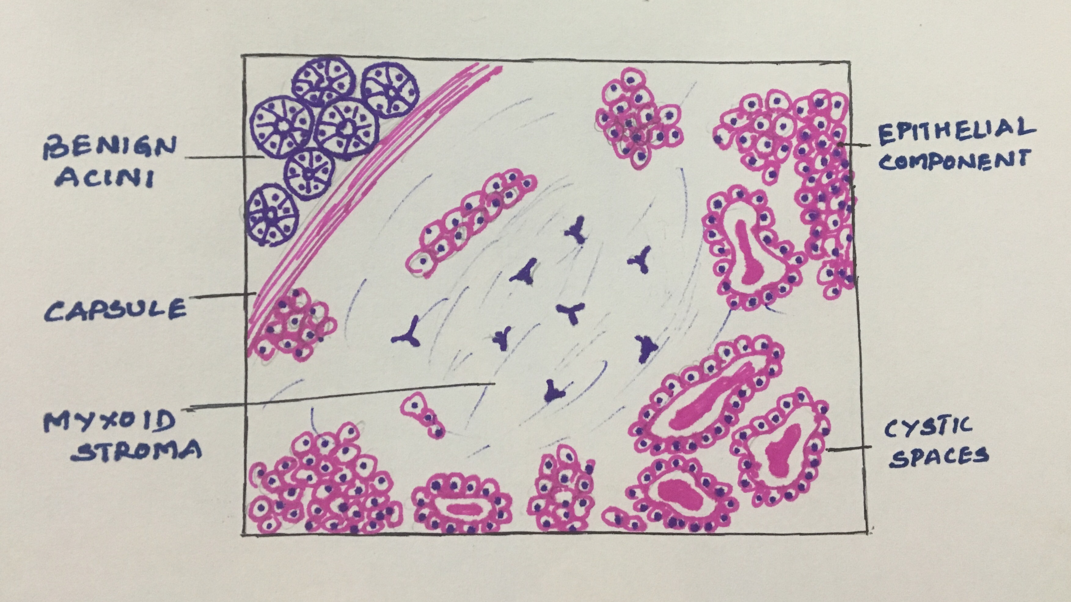 pleomorphic adenoma histology drawing