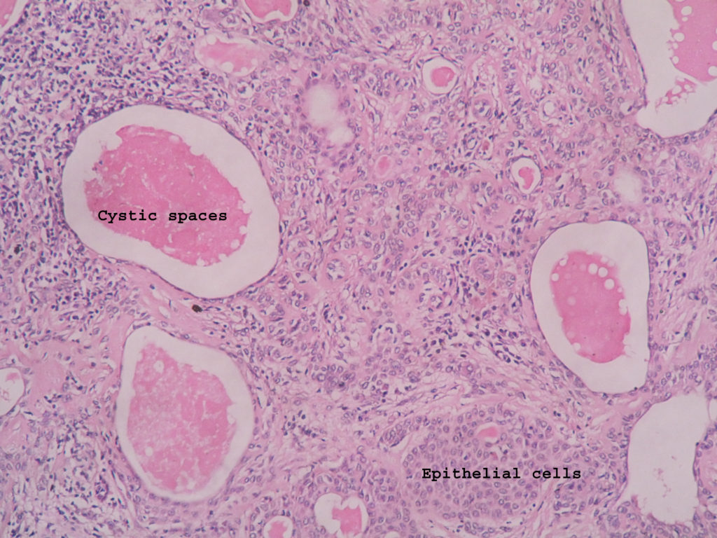 pleomorphic adenoma histology labelled