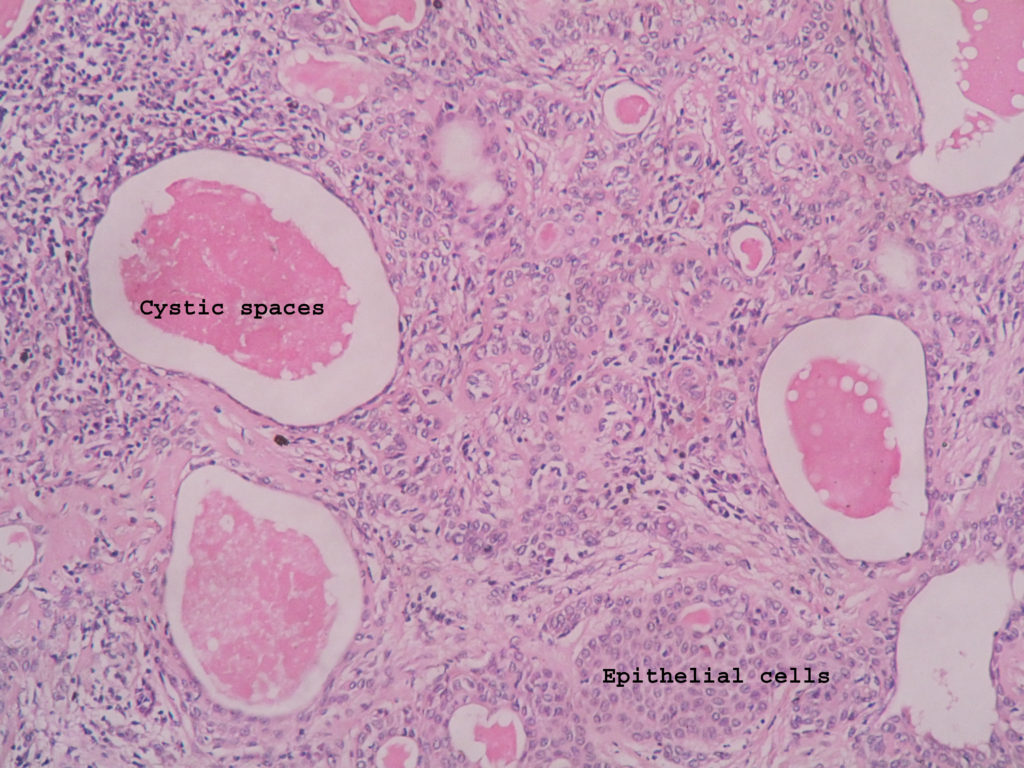 pleomorphic adenoma histology drawing