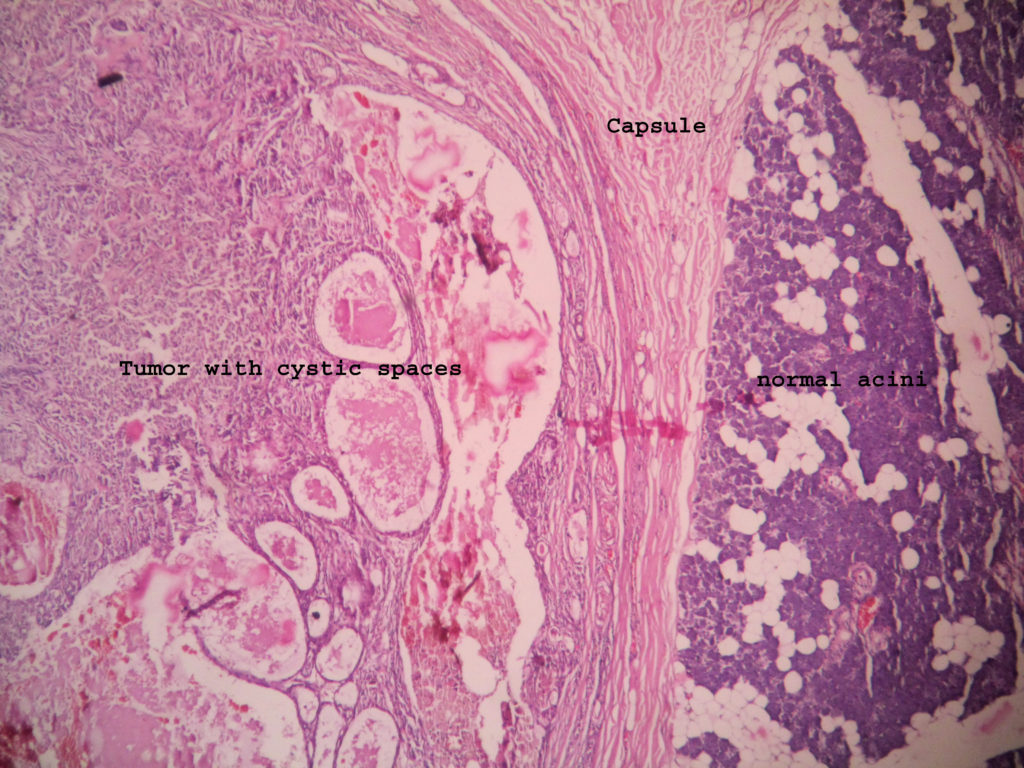 pleomorphic adenoma histology drawing