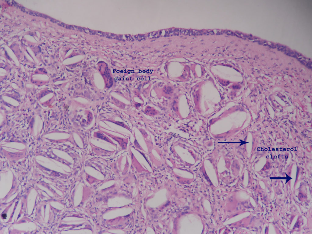 Branchial Cleft Cyst Histopathology guru