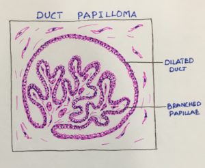 Intraductal papilloma transformation, Oxiuros zentel, Intraductal papilloma histopathology