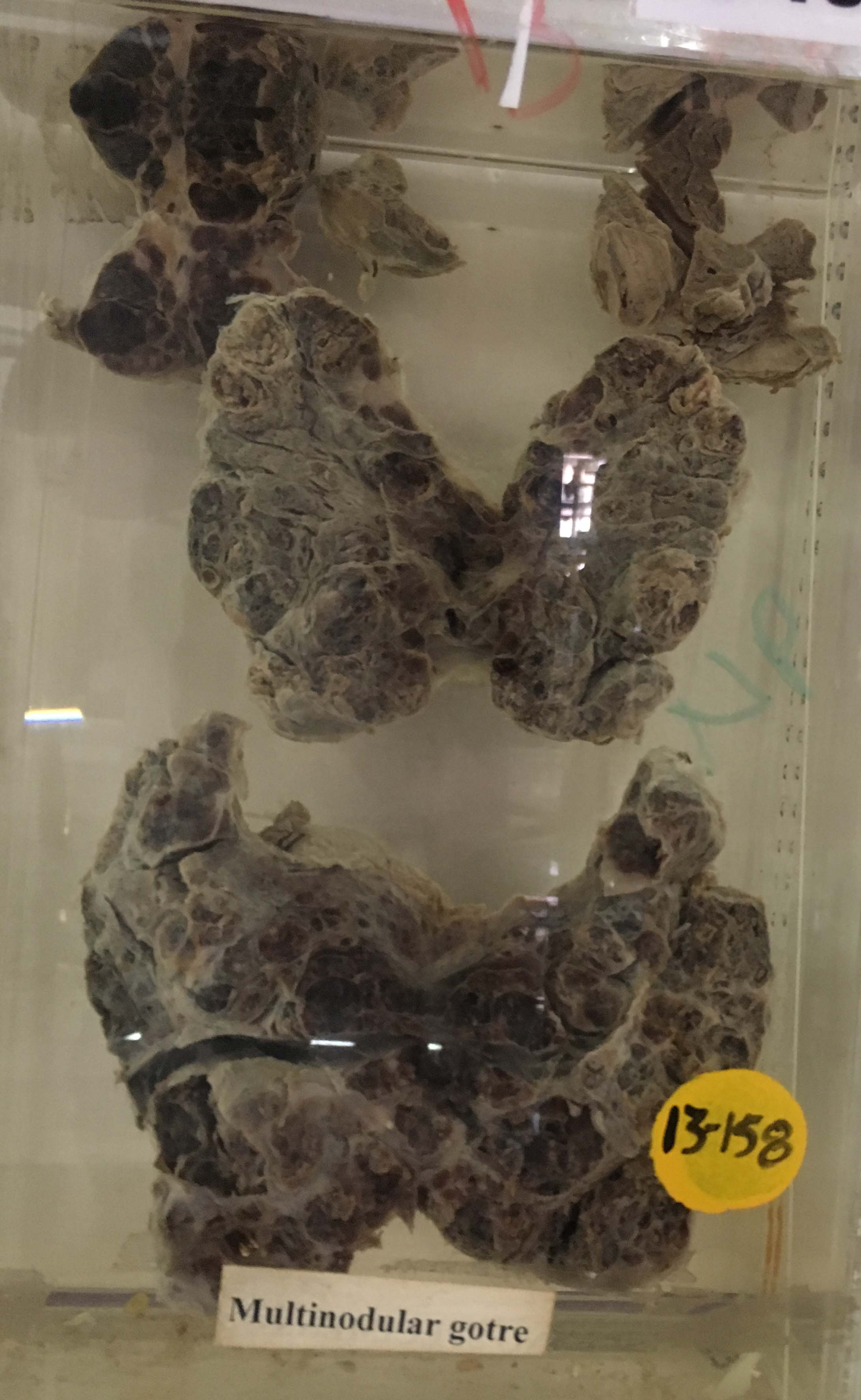 icd 10 code for nodular goitre