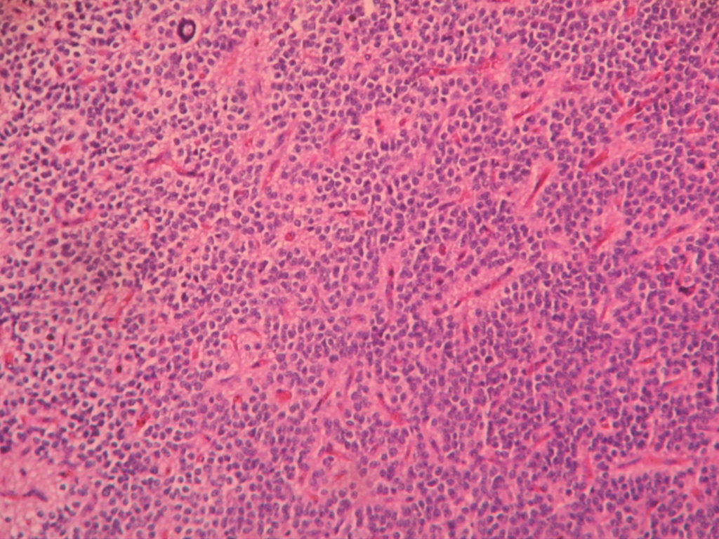 OLIGODENDROGLIOMA – Histopathology.guru