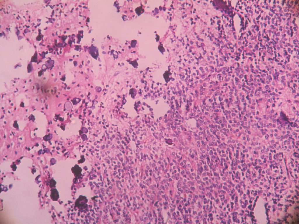 OLIGODENDROGLIOMA – Histopathology.guru
