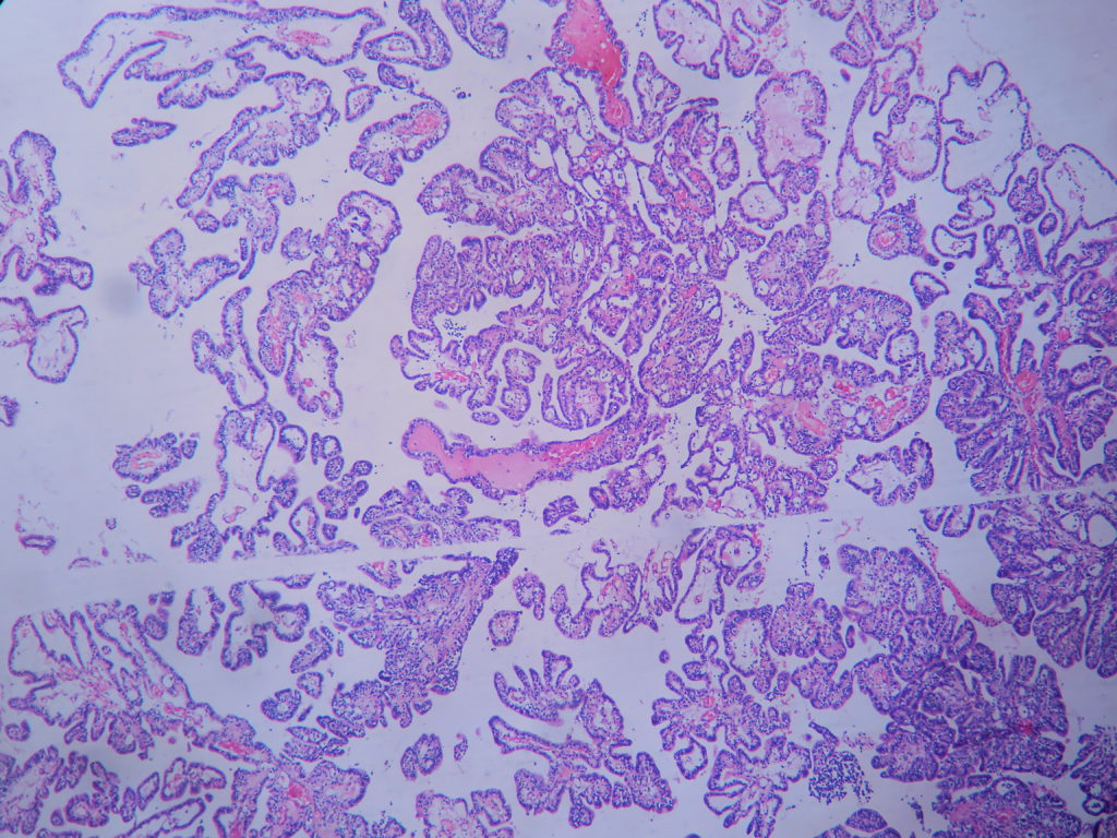 choroid plexus papilloma hisztopathology)