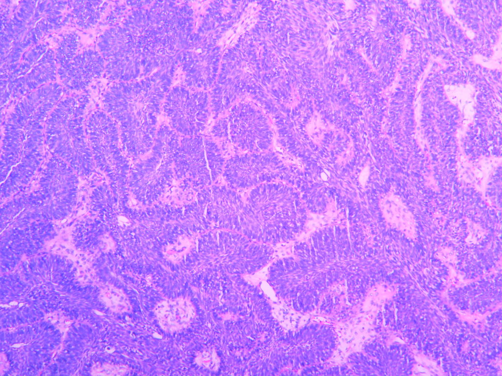 right inverted papilloma icd 10
