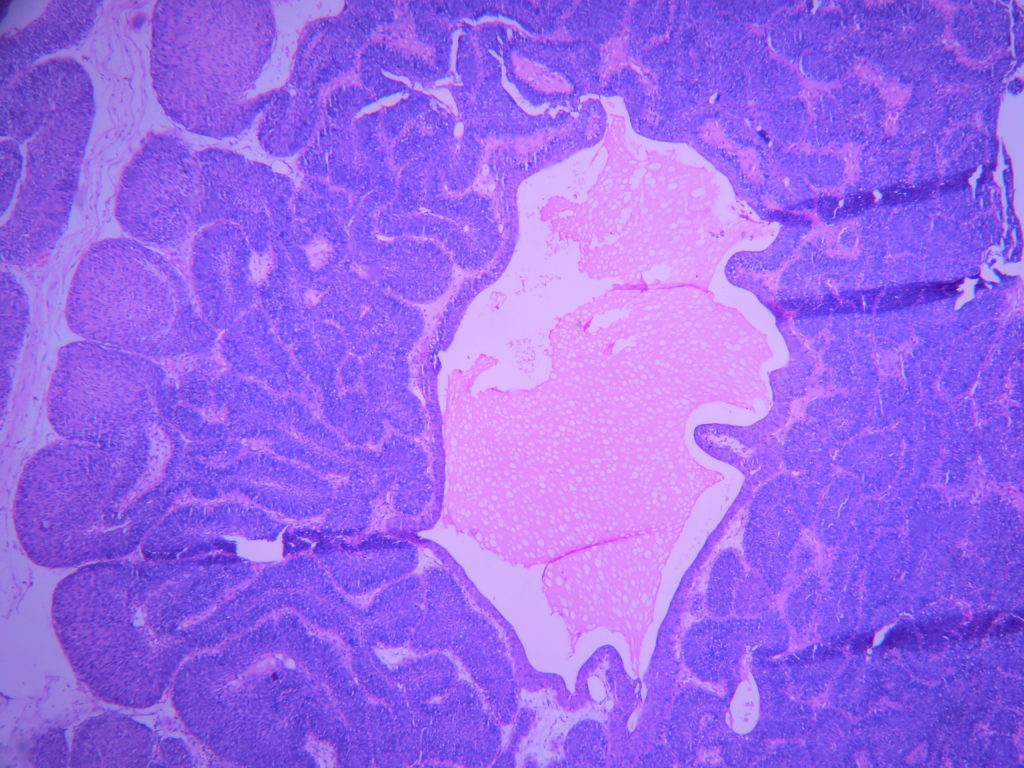 history of inverted papilloma. icd-10