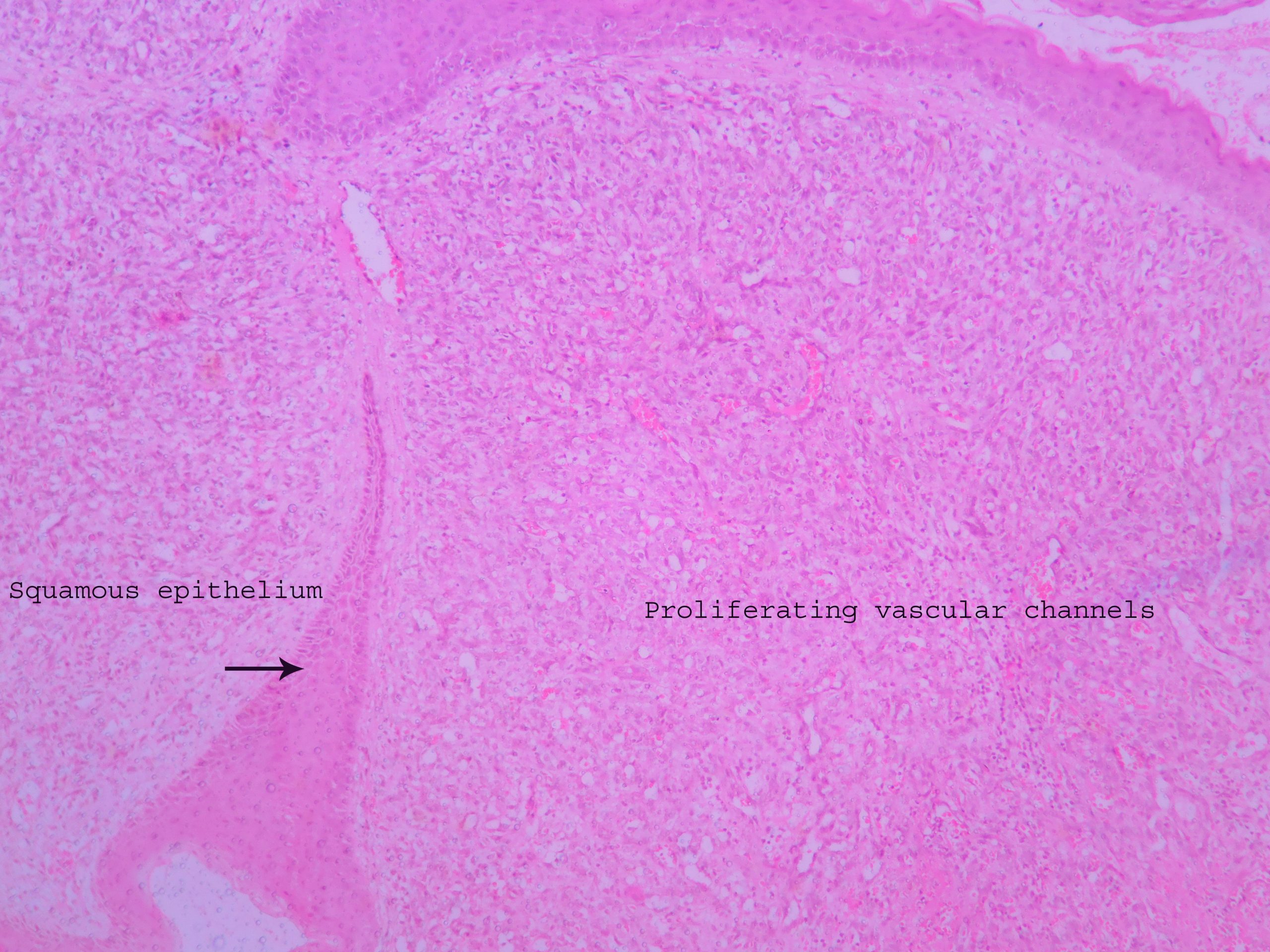 Capillary Hemangioma Histopathology guru capillary-hemangioma-histopathology-guru