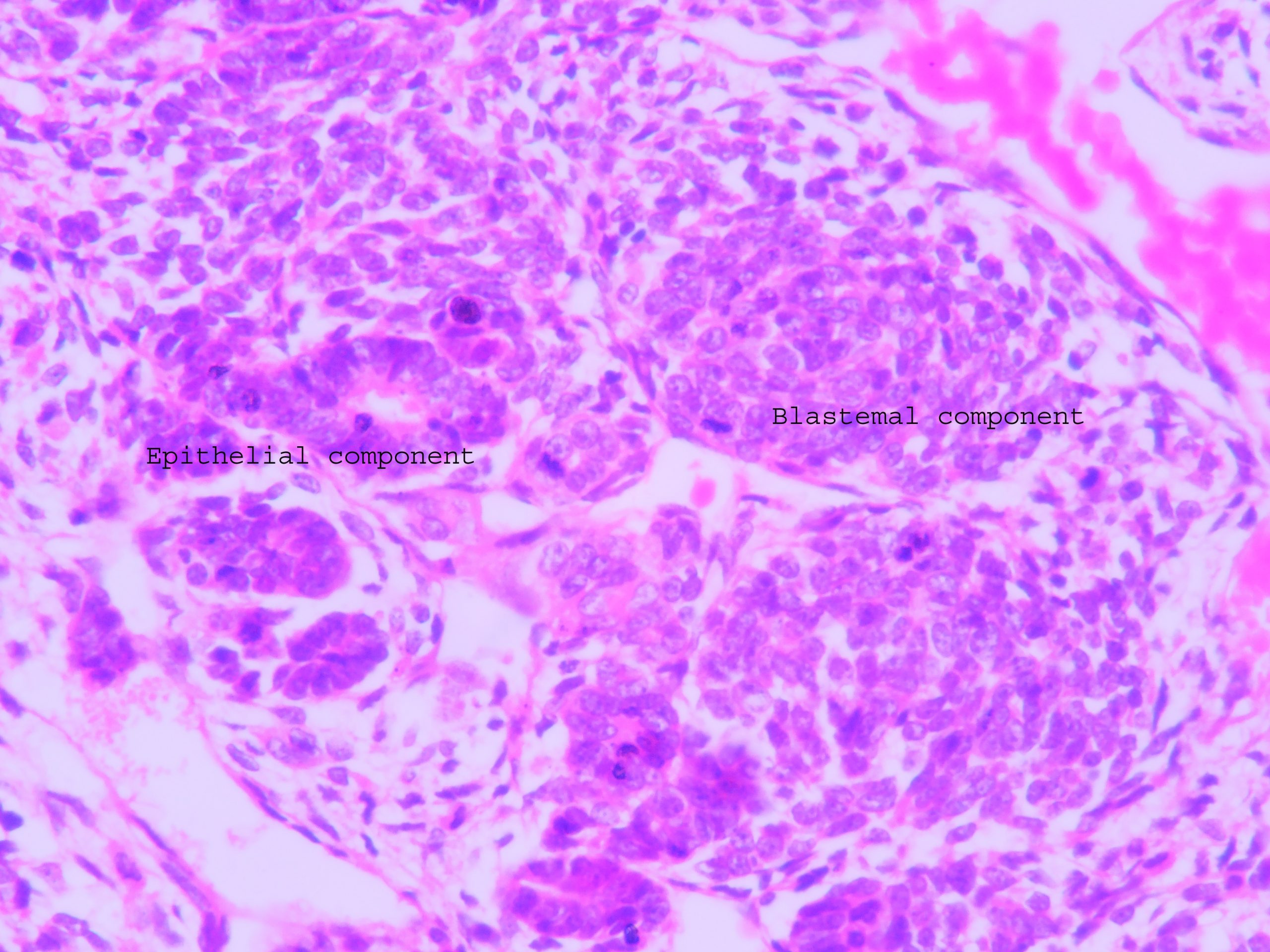 icd 10 cm code for wilms tumor left