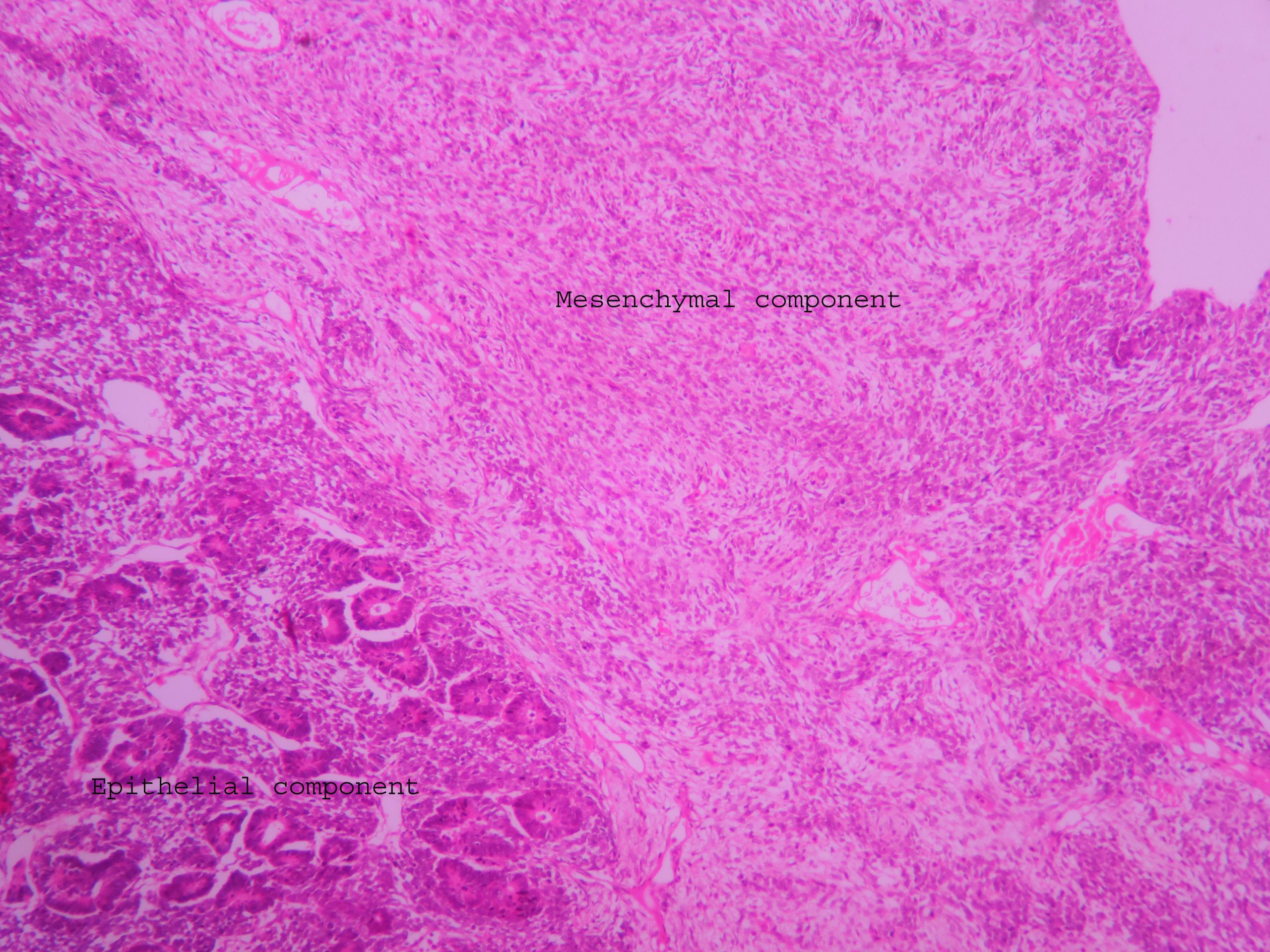 icd 10 code for wilms tumor left