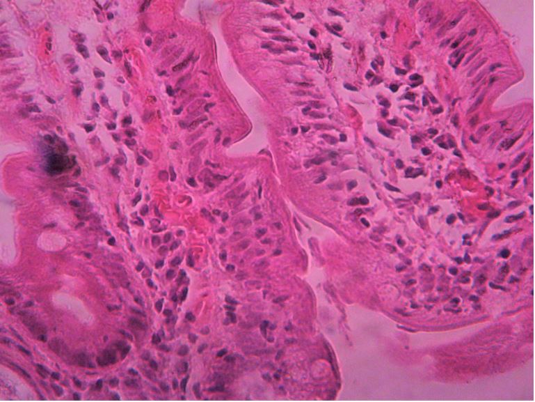 Giardia duodenum pathology