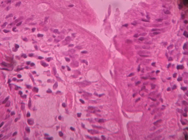 Giardia duodenum histopathology Giardiasis duodenum histology