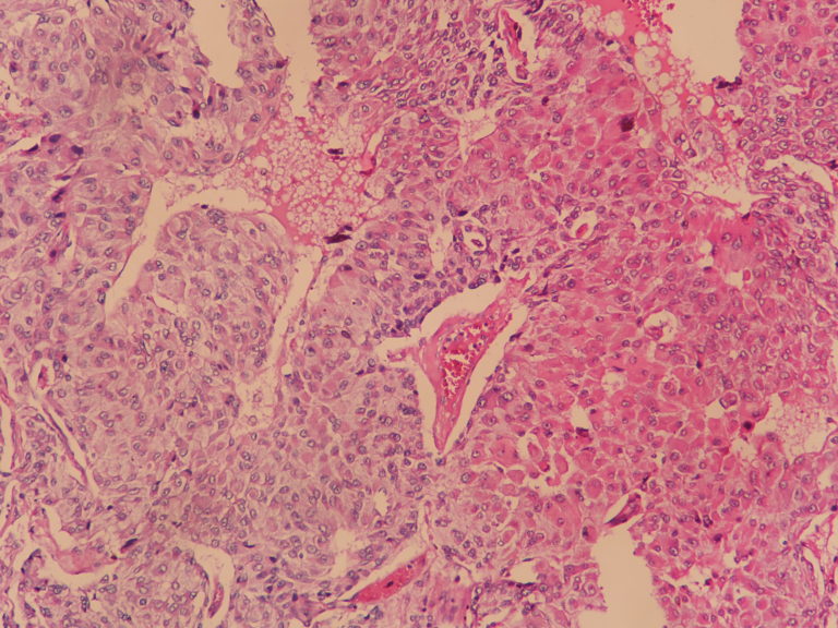 adrenal-cortical-carcinoma-histopathology-guru