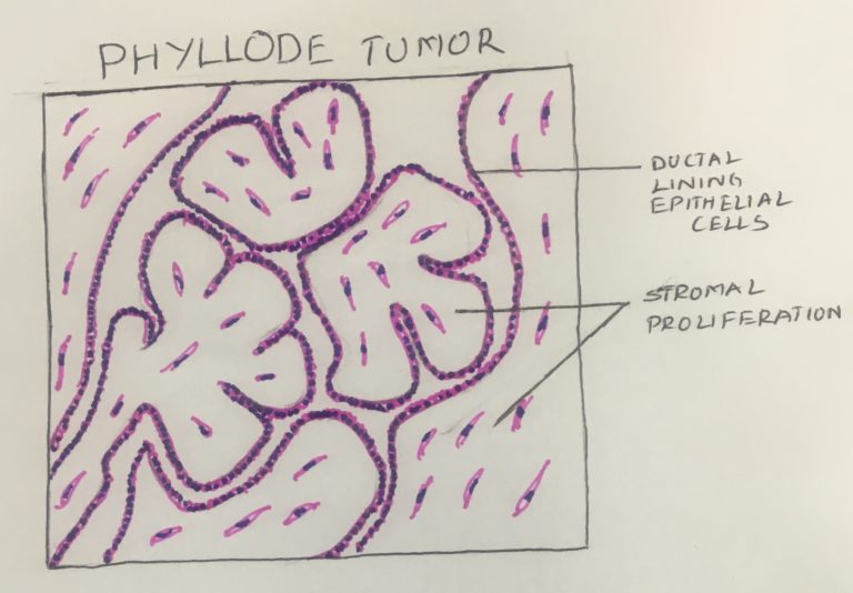 Phyllodes Tumor Histopathology guru