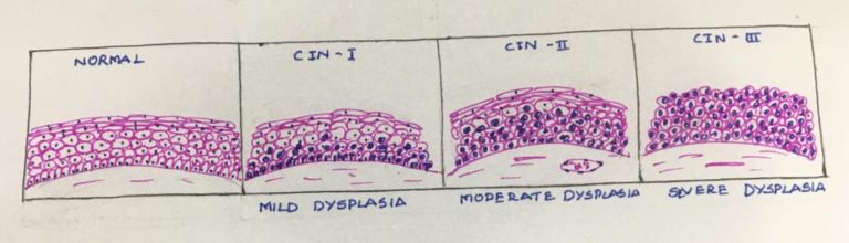 Cervical intraepithelial neoplasia – Histopathology.guru
