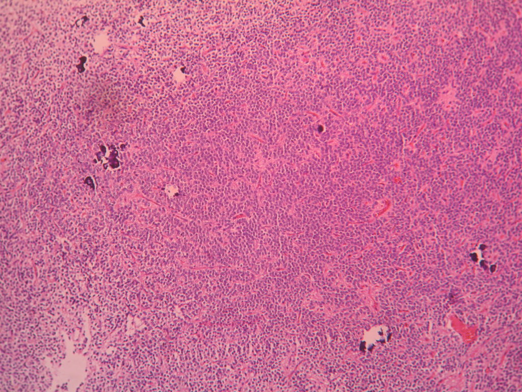 OLIGODENDROGLIOMA – Histopathology.guru