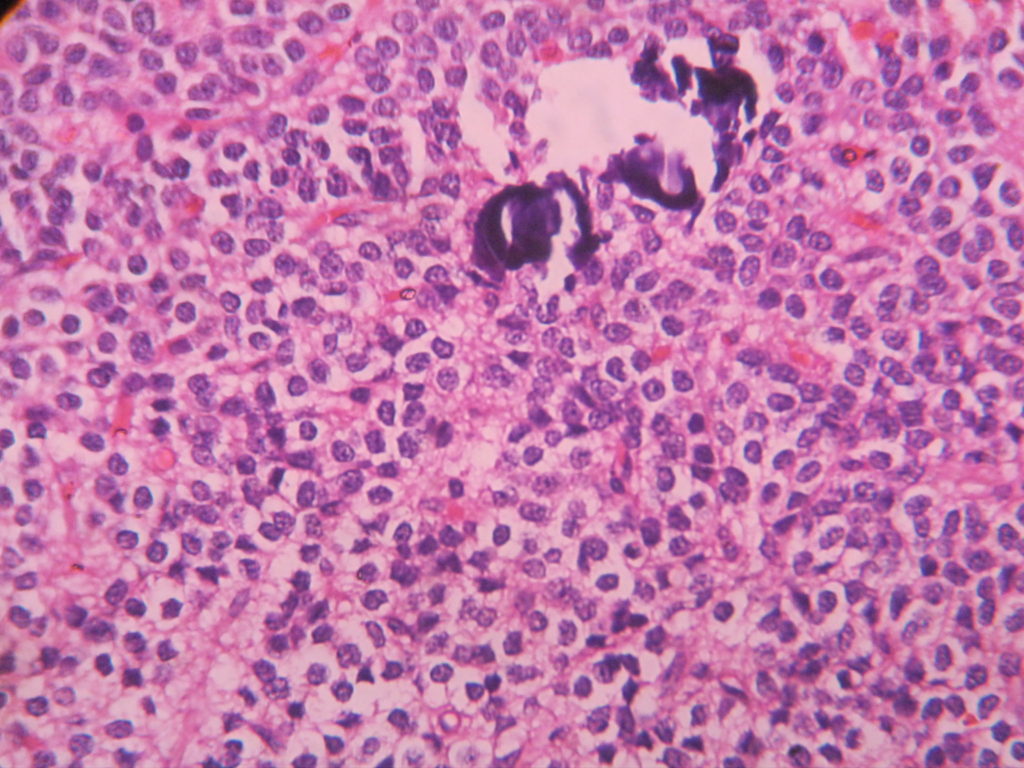OLIGODENDROGLIOMA – Histopathology.guru
