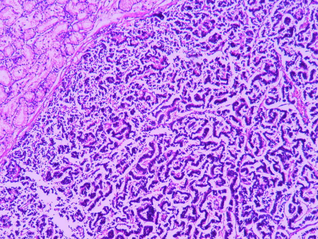 CARCINOID – SMALL INTESTINE – Histopathology.guru