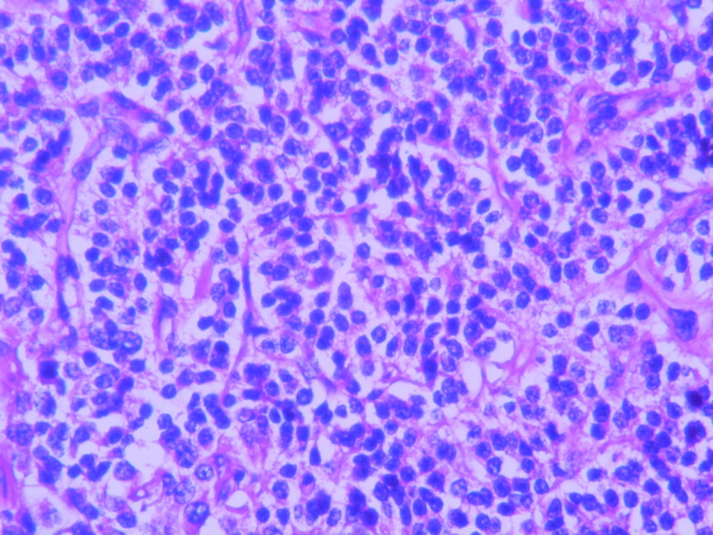 CARCINOID – SMALL INTESTINE – Histopathology.guru