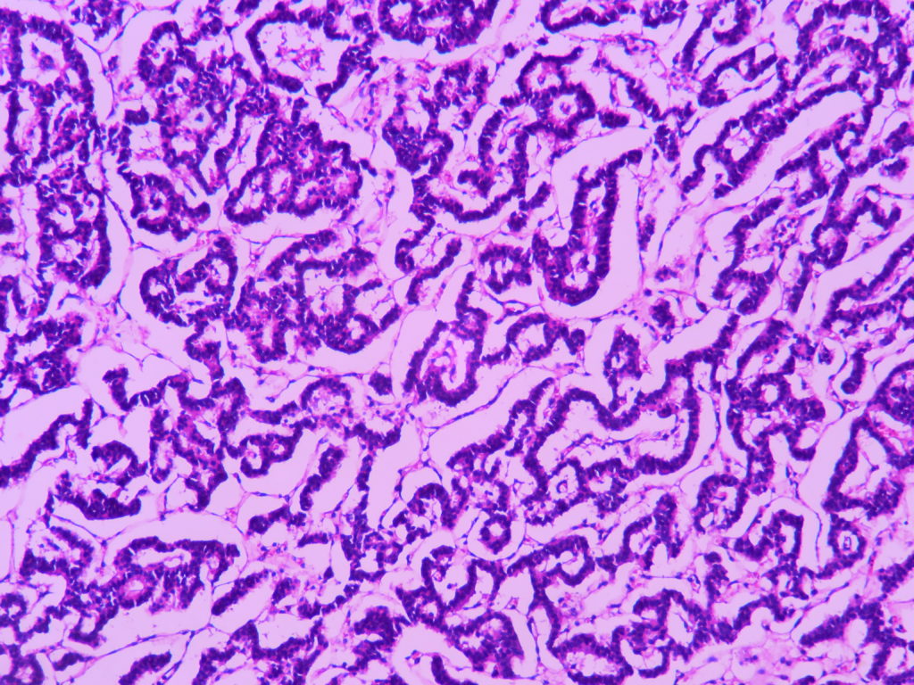 CARCINOID – SMALL INTESTINE – Histopathology.guru