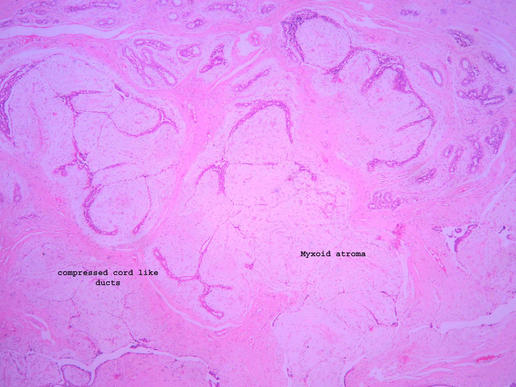 Fibroadenoma Histopathologyguru